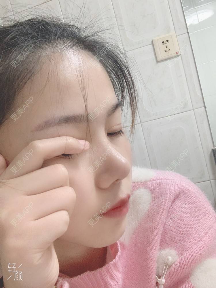 更美 - 浃浃！的厚唇改薄经验 | 厚唇改薄 | 上海