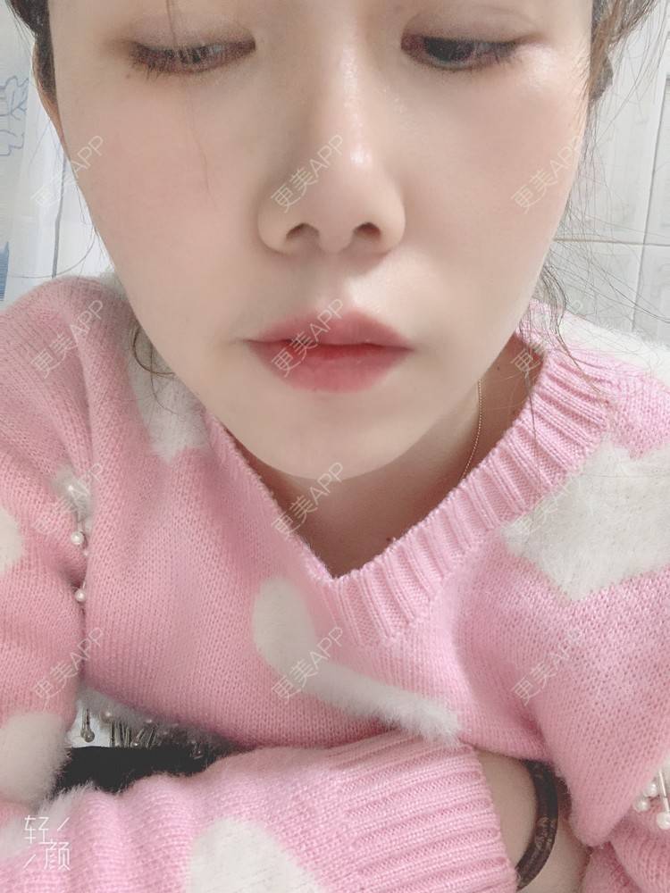 更美 - 浃浃！的厚唇改薄经验 | 厚唇改薄 | 上海