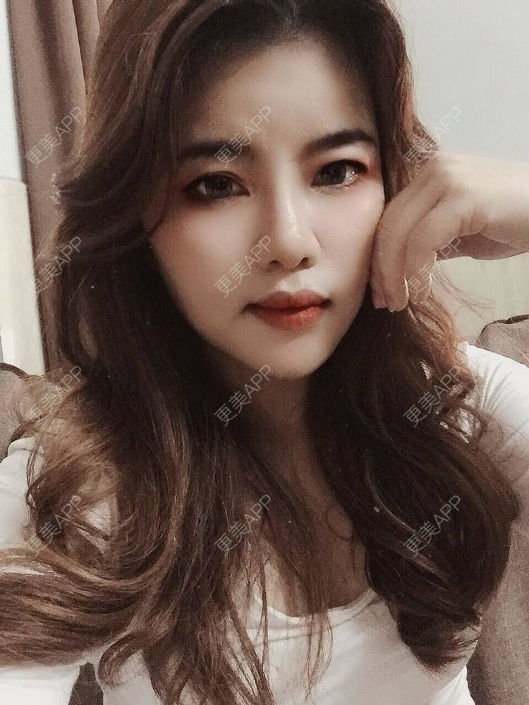 更美 - Edith 、Z的自体脂肪丰苹果肌经验 | 自体脂肪丰额头 | 自体脂肪丰面颊 | 自体脂肪丰太阳穴 | 自体脂肪丰苹果肌 | 广州