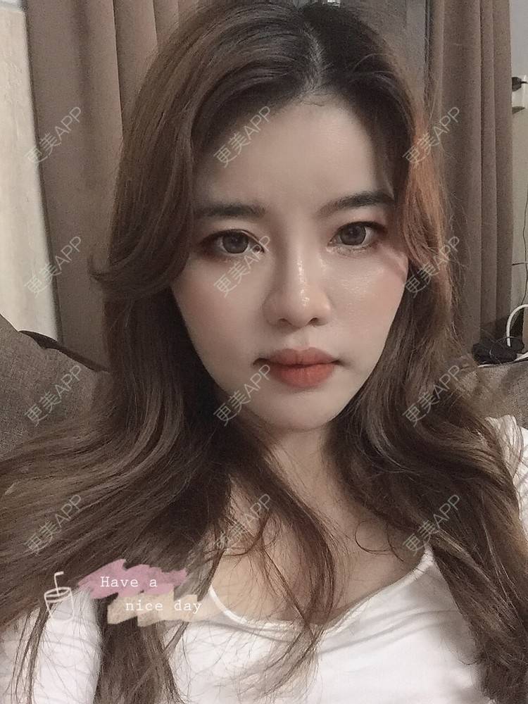 更美 - Edith 、Z的自体脂肪丰苹果肌经验 | 自体脂肪丰额头 | 自体脂肪丰面颊 | 自体脂肪丰太阳穴 | 自体脂肪丰苹果肌 | 广州