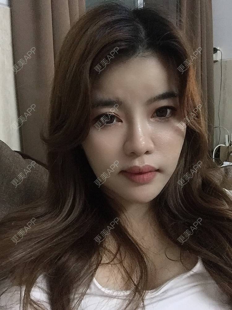 更美 - Edith 、Z的自体脂肪丰苹果肌经验 | 自体脂肪丰额头 | 自体脂肪丰面颊 | 自体脂肪丰太阳穴 | 自体脂肪丰苹果肌 | 广州