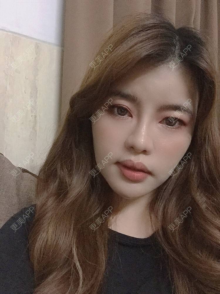 更美 - Edith 、Z的自体脂肪丰苹果肌经验 | 自体脂肪丰额头 | 自体脂肪丰面颊 | 自体脂肪丰太阳穴 | 自体脂肪丰苹果肌 | 广州