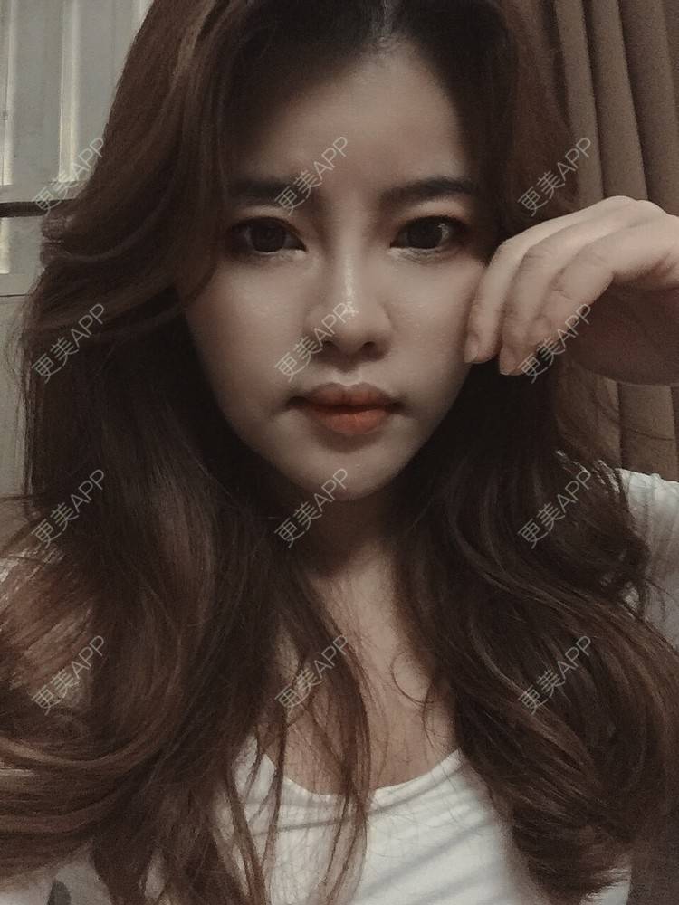 更美 - Edith 、Z的自体脂肪丰苹果肌经验 | 自体脂肪丰额头 | 自体脂肪丰面颊 | 自体脂肪丰太阳穴 | 自体脂肪丰苹果肌 | 广州