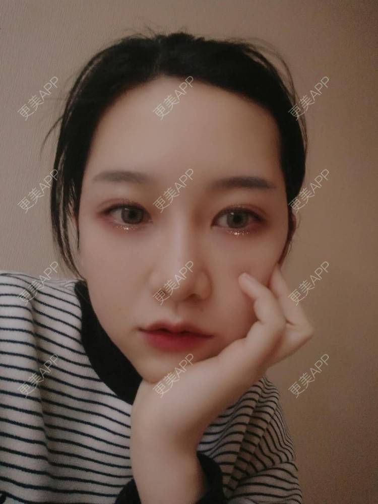 更美 - 徒劳兔的自体脂肪垫下巴经验 | 自体脂肪垫下巴 | 自体脂肪丰太阳穴 | 台州 | 自体脂肪丰卧蚕
