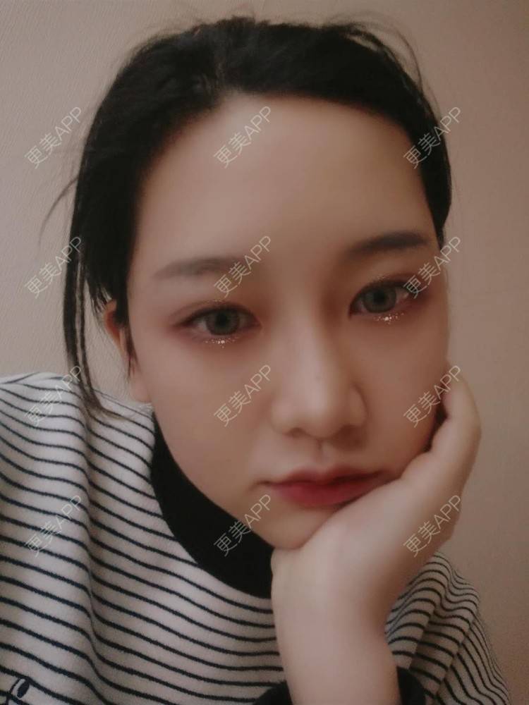 更美 - 徒劳兔的自体脂肪垫下巴经验 | 自体脂肪垫下巴 | 自体脂肪丰太阳穴 | 台州 | 自体脂肪丰卧蚕