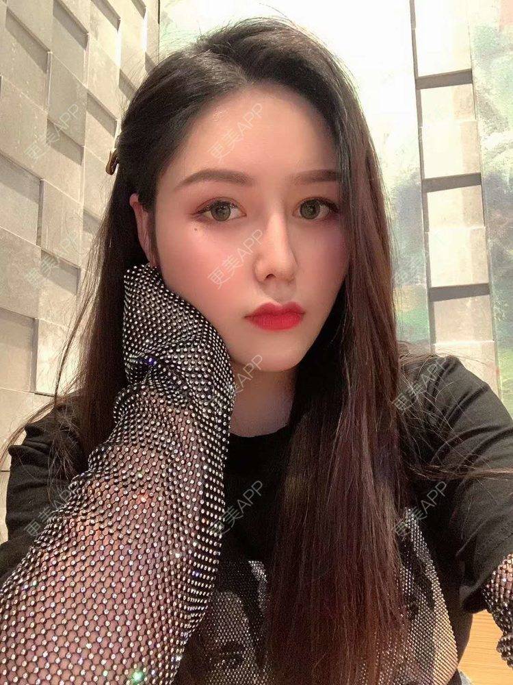 更美 - 更美用户dapPewZ45A的自体脂肪丰额头经验 | 视频日记 | 自体脂肪丰额头 | 重庆