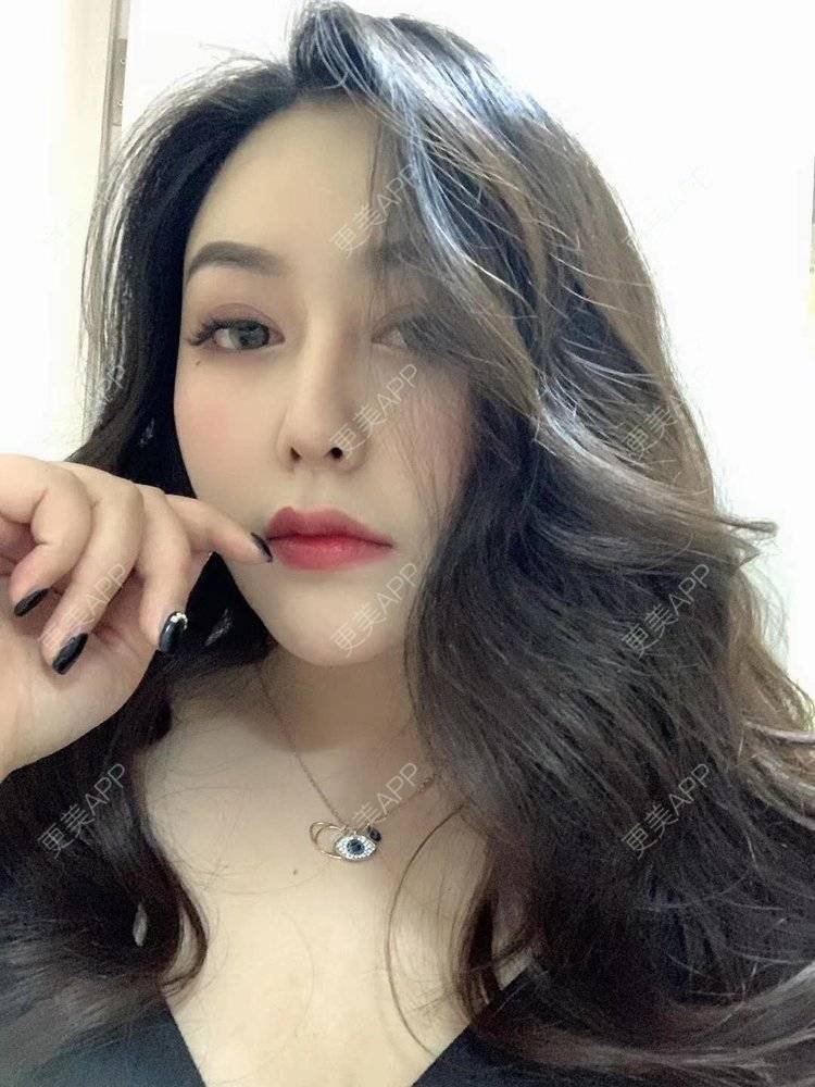 更美 - 更美用户dapPewZ45A的自体脂肪丰额头经验 | 视频日记 | 自体脂肪丰额头 | 重庆