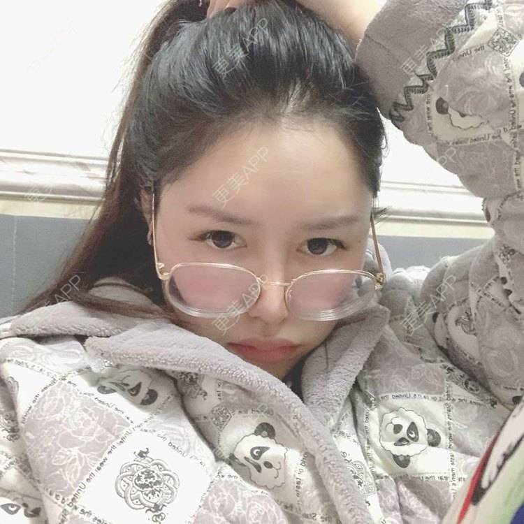 更美 - 更美用户dapPewZ45A的自体脂肪丰额头经验 | 视频日记 | 自体脂肪丰额头 | 重庆