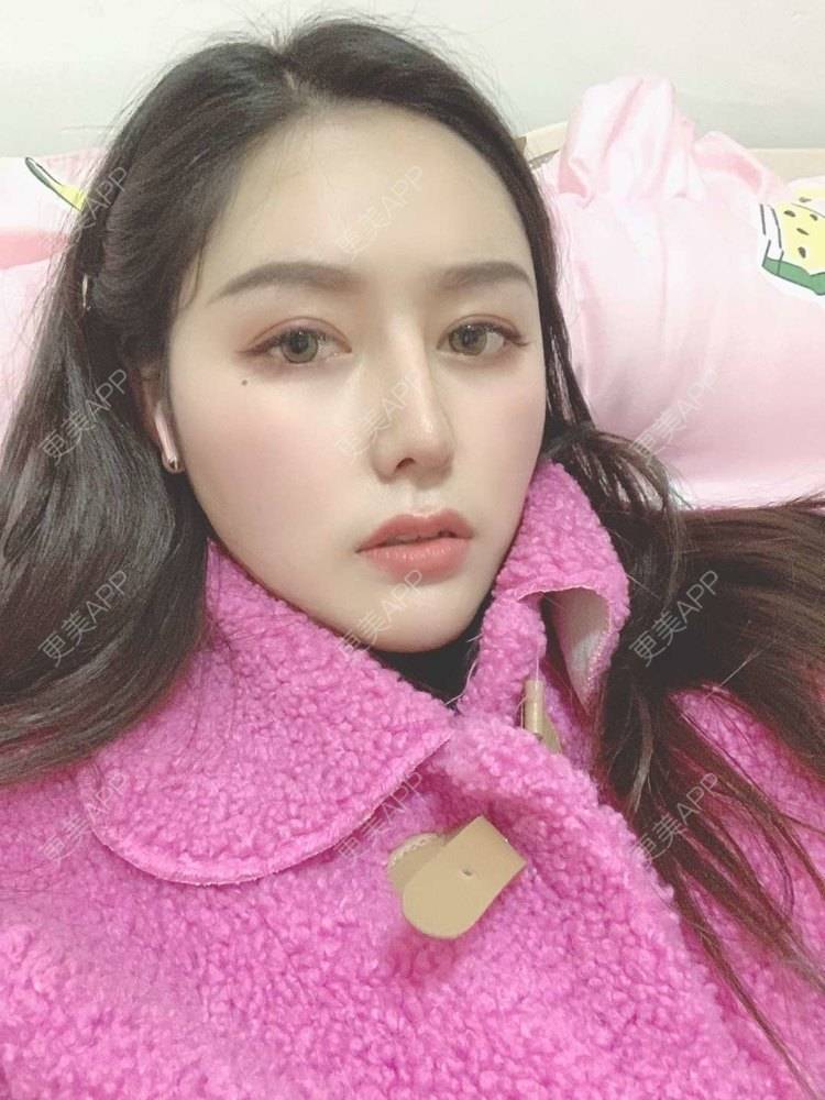 更美 - 更美用户dapPewZ45A的自体脂肪丰额头经验 | 视频日记 | 自体脂肪丰额头 | 重庆