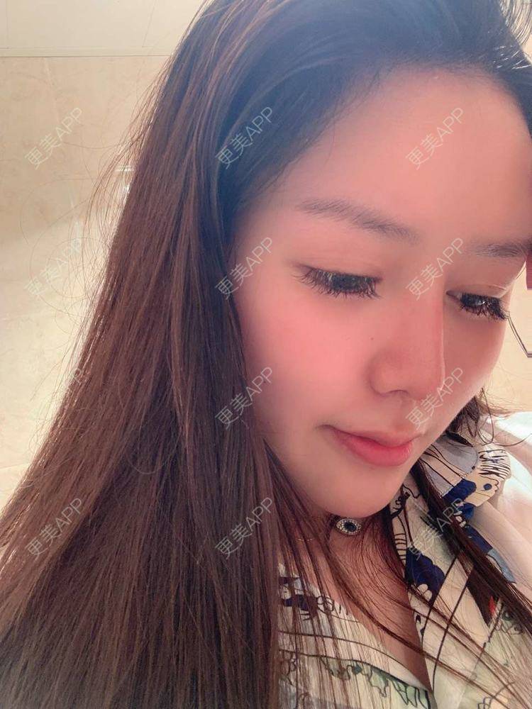 更美 - 更美用户dapPewZ45A的自体脂肪丰额头经验 | 视频日记 | 自体脂肪丰额头 | 重庆