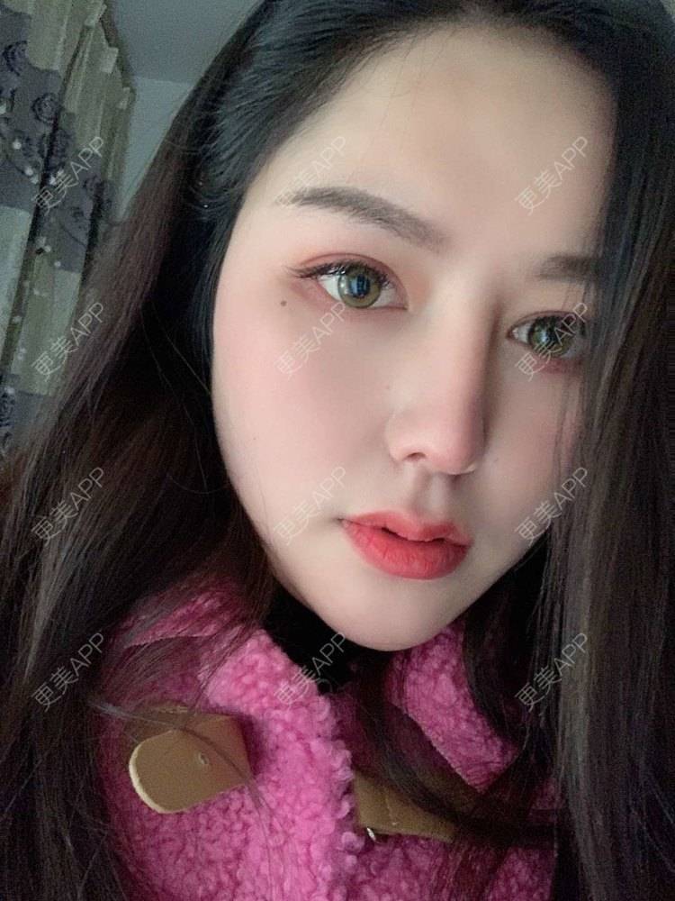 更美 - 更美用户dapPewZ45A的自体脂肪丰额头经验 | 视频日记 | 自体脂肪丰额头 | 重庆