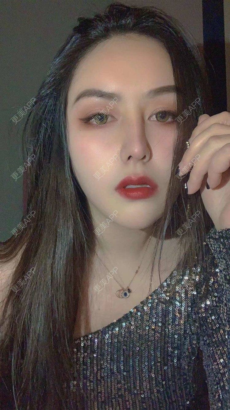 更美 - 更美用户dapPewZ45A的自体脂肪丰额头经验 | 视频日记 | 自体脂肪丰额头 | 重庆