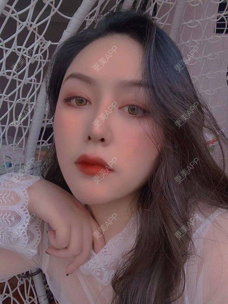 更美 - 更美用户dapPewZ45A的自体脂肪丰额头经验 | 视频日记 | 自体脂肪丰额头 | 重庆