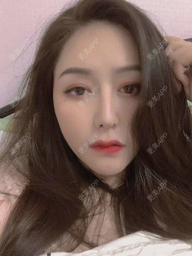 更美 - 更美用户dapPewZ45A的自体脂肪丰额头经验 | 视频日记 | 自体脂肪丰额头 | 重庆