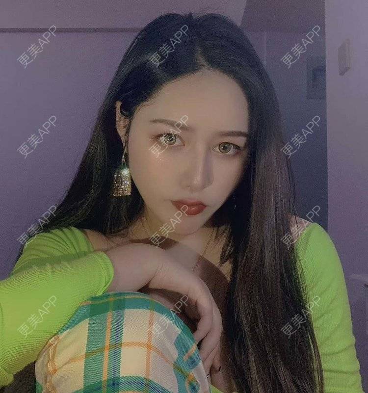 更美 - 更美用户dapPewZ45A的自体脂肪丰额头经验 | 视频日记 | 自体脂肪丰额头 | 重庆