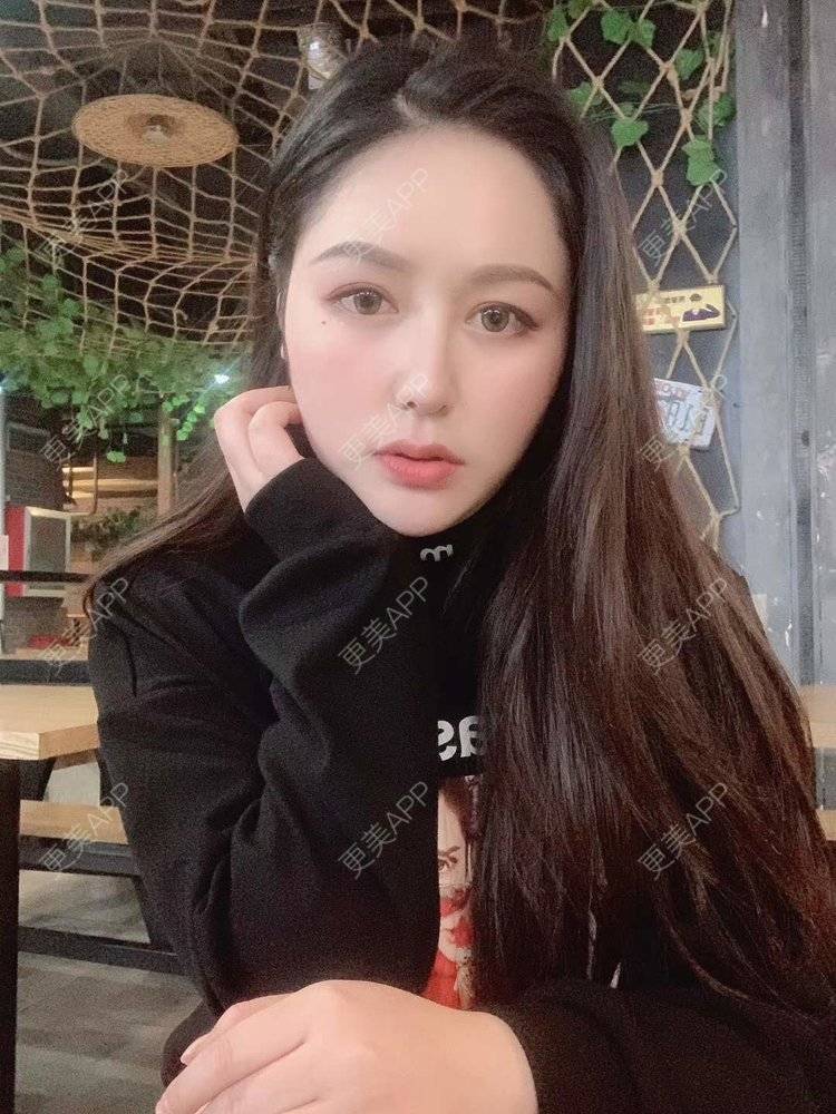 更美 - 更美用户dapPewZ45A的自体脂肪丰额头经验 | 视频日记 | 自体脂肪丰额头 | 重庆