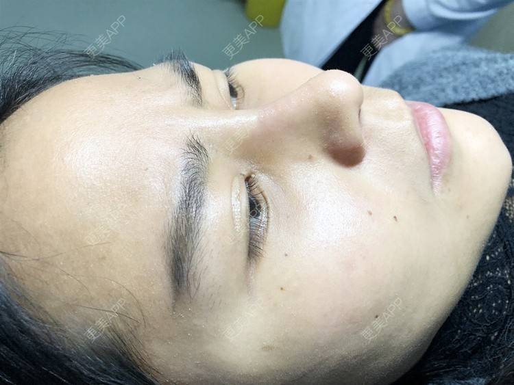 更美 - 更美用户zwQN5e8jIh的鼻部多项经验 | 鼻部多项 | 长沙