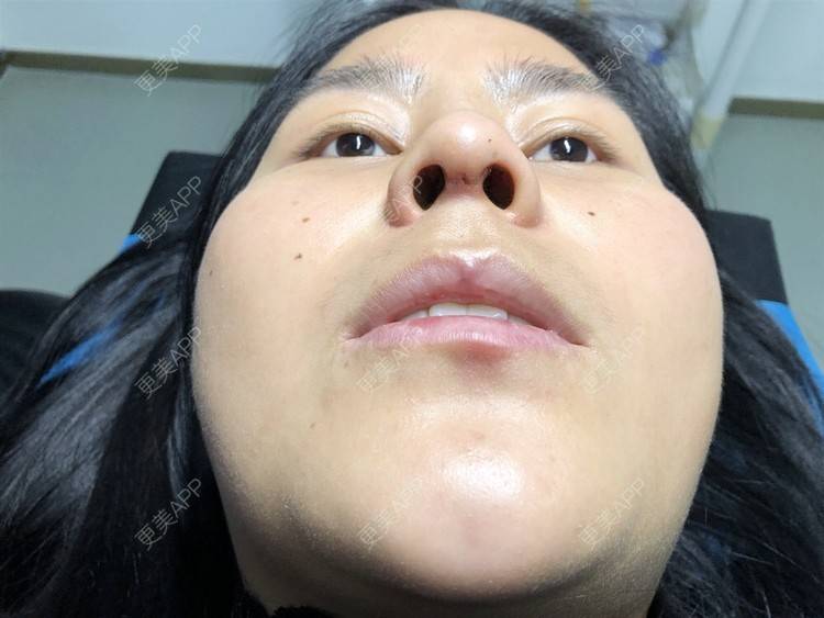 更美 - 更美用户zwQN5e8jIh的鼻部多项经验 | 鼻部多项 | 长沙