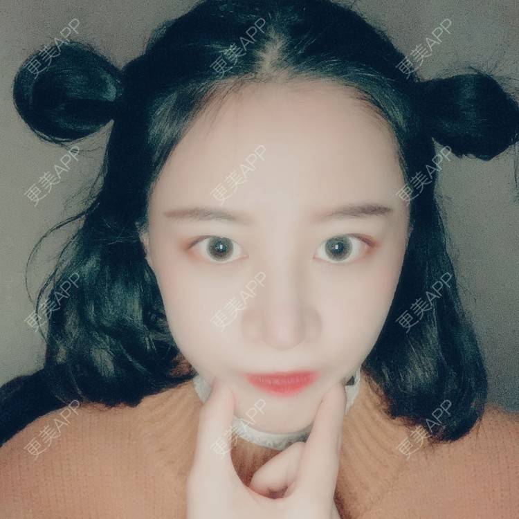 更美 - 蔓蔓不慢哦的全切双眼皮经验 | 全切双眼皮 | 眼皮下垂矫正 | 重庆 | 双眼皮修复 | 上眼睑去脂 | 眼部多项 | 开眼角修复 | 提眉修复