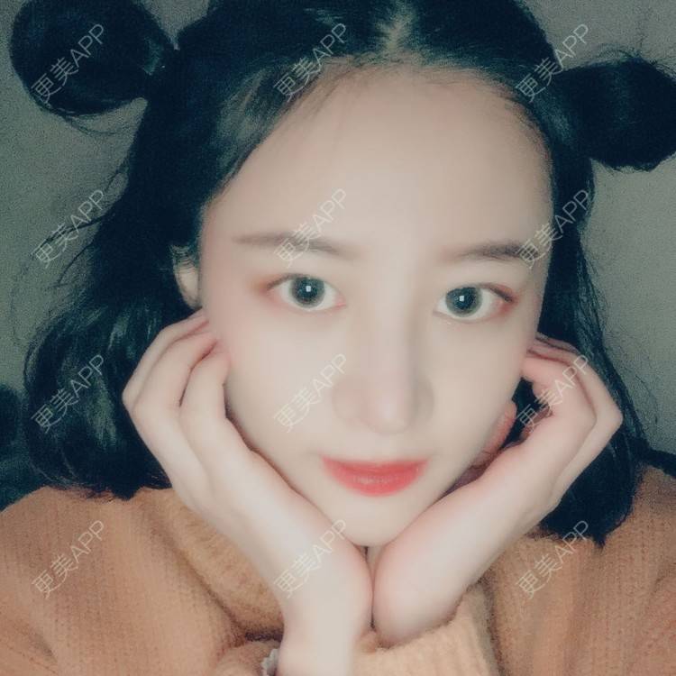 更美 - 蔓蔓不慢哦的全切双眼皮经验 | 全切双眼皮 | 眼皮下垂矫正 | 重庆 | 双眼皮修复 | 上眼睑去脂 | 眼部多项 | 开眼角修复 | 提眉修复