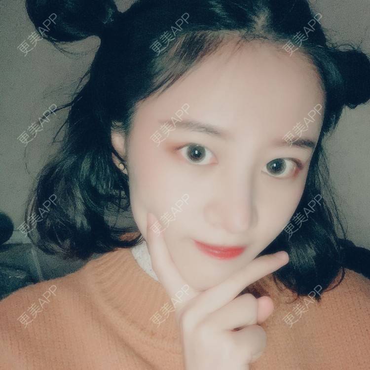 更美 - 蔓蔓不慢哦的全切双眼皮经验 | 全切双眼皮 | 眼皮下垂矫正 | 重庆 | 双眼皮修复 | 上眼睑去脂 | 眼部多项 | 开眼角修复 | 提眉修复