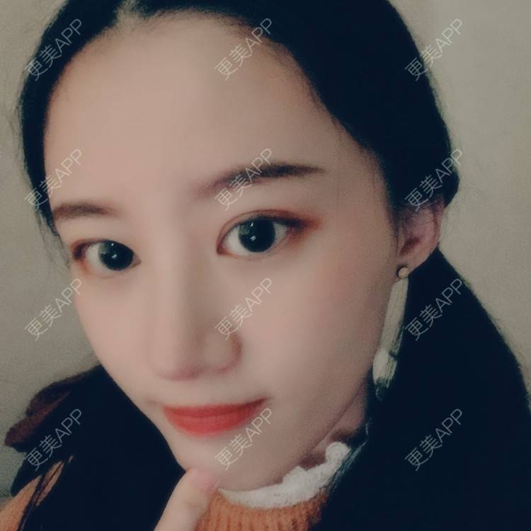 更美 - 蔓蔓不慢哦的全切双眼皮经验 | 全切双眼皮 | 眼皮下垂矫正 | 重庆 | 双眼皮修复 | 上眼睑去脂 | 眼部多项 | 开眼角修复 | 提眉修复