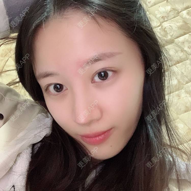 更美 - 蔓蔓不慢哦的全切双眼皮经验 | 全切双眼皮 | 眼皮下垂矫正 | 重庆 | 双眼皮修复 | 上眼睑去脂 | 眼部多项 | 开眼角修复 | 提眉修复