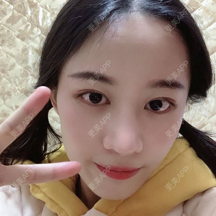 更美 - 蔓蔓不慢哦的全切双眼皮经验 | 全切双眼皮 | 眼皮下垂矫正 | 重庆 | 双眼皮修复 | 上眼睑去脂 | 眼部多项 | 开眼角修复 | 提眉修复