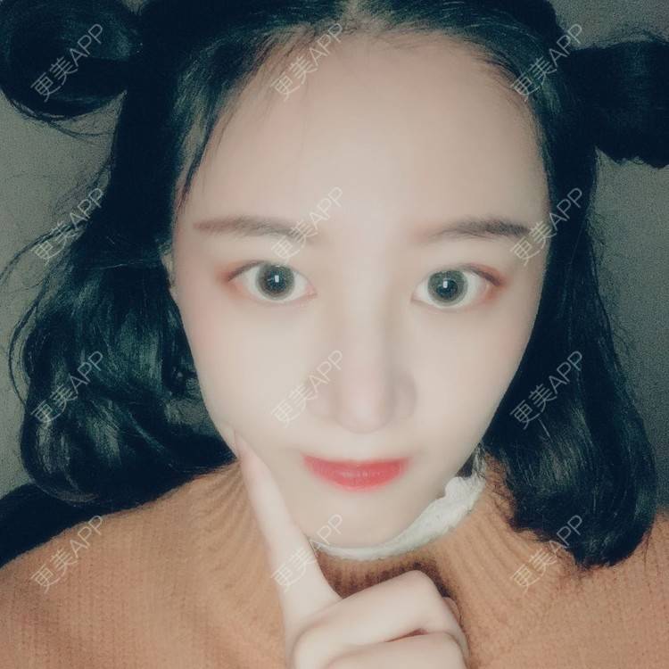 更美 - 蔓蔓不慢哦的全切双眼皮经验 | 全切双眼皮 | 眼皮下垂矫正 | 重庆 | 双眼皮修复 | 上眼睑去脂 | 眼部多项 | 开眼角修复 | 提眉修复