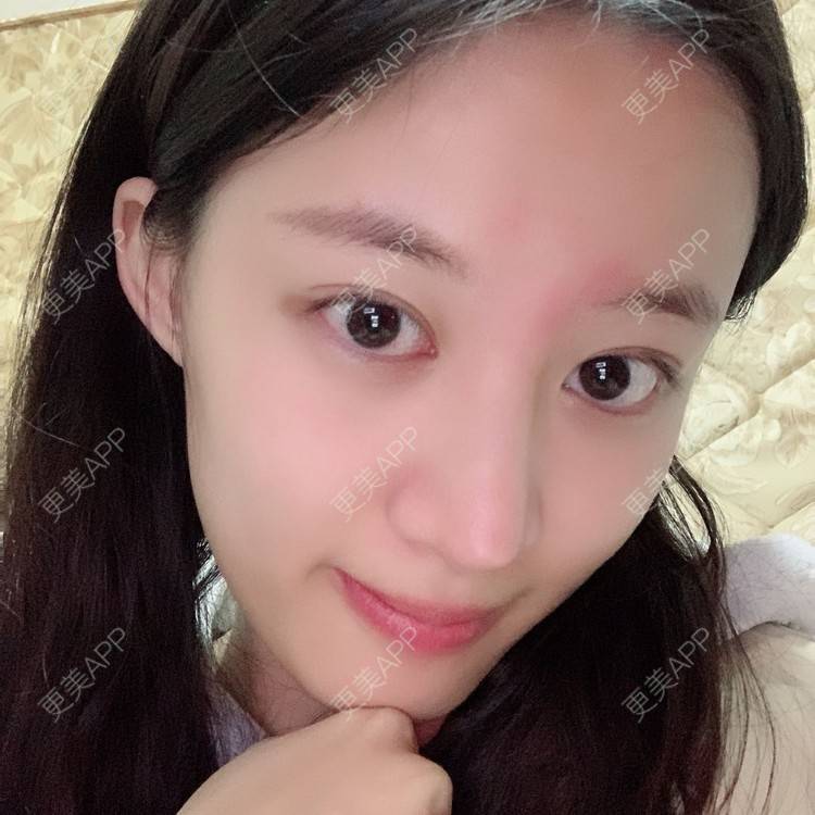 更美 - 蔓蔓不慢哦的全切双眼皮经验 | 全切双眼皮 | 眼皮下垂矫正 | 重庆 | 双眼皮修复 | 上眼睑去脂 | 眼部多项 | 开眼角修复 | 提眉修复