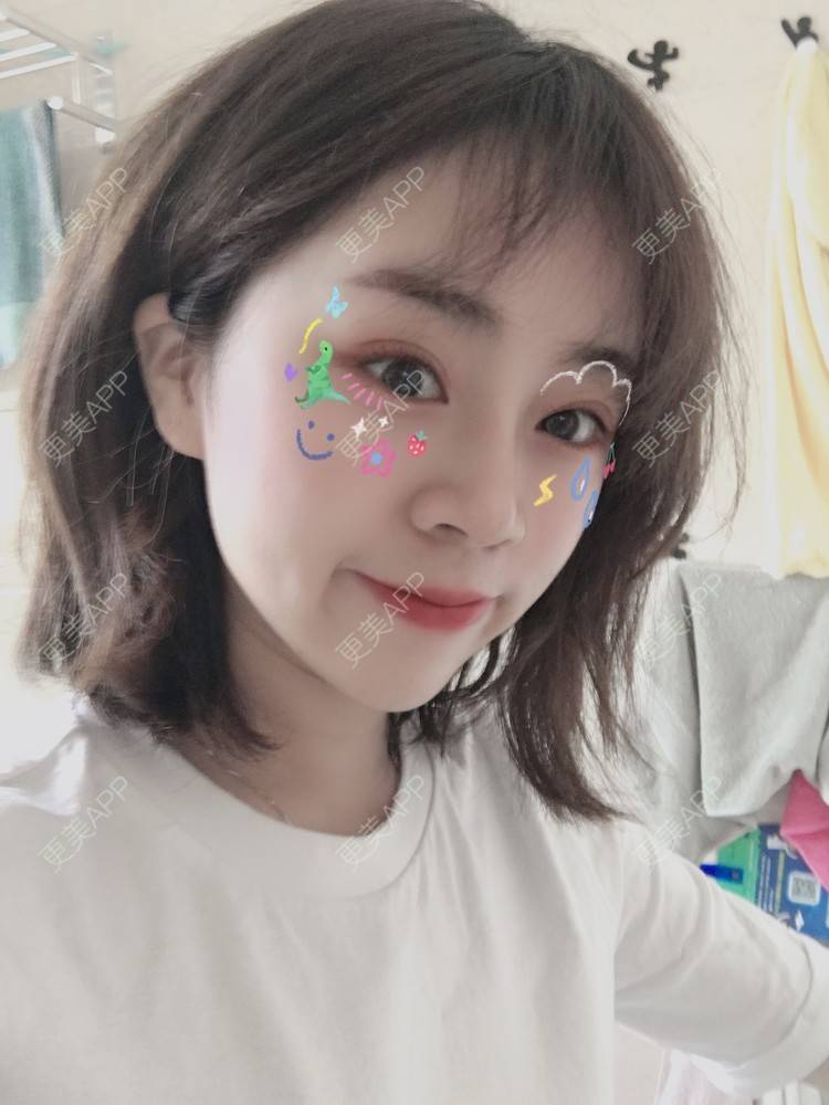 更美 - 小毛毛的夏天的全切双眼皮经验 | 视频日记 | 全切双眼皮 | 宜昌