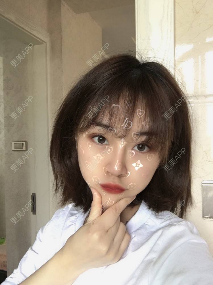 更美 - 小毛毛的夏天的全切双眼皮经验 | 视频日记 | 全切双眼皮 | 宜昌