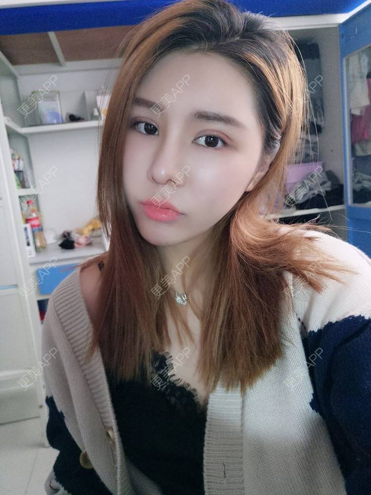 更美 - 更美用户psx6LnSZEo的点阵激光经验 | 成都 | 彩光嫩肤 | 点阵激光 | 超声提升 | 除皱瘦脸