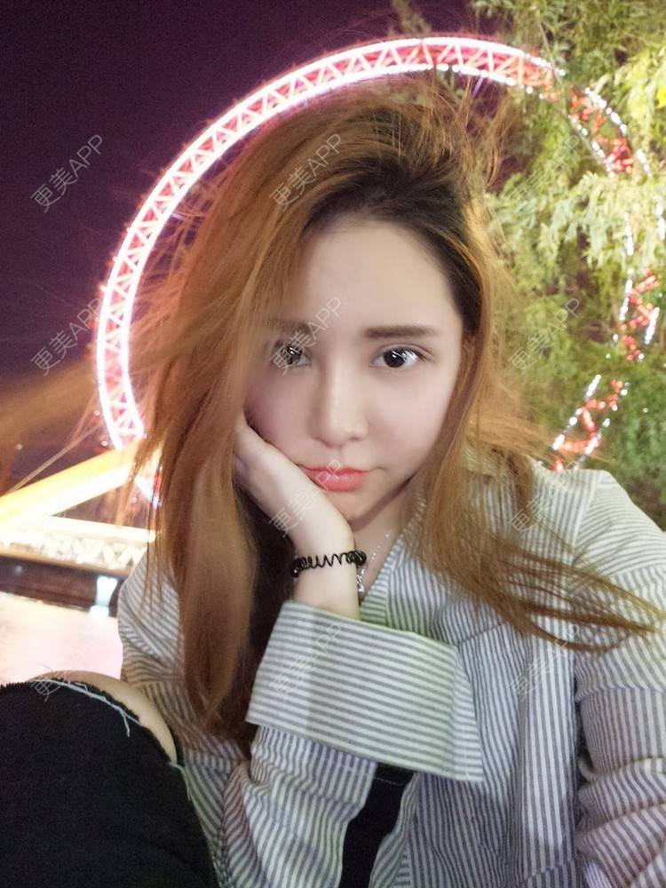 更美 - 更美用户psx6LnSZEo的点阵激光经验 | 成都 | 彩光嫩肤 | 点阵激光 | 超声提升 | 除皱瘦脸