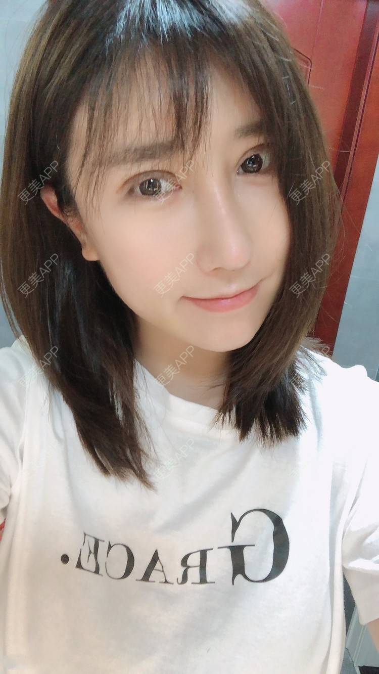 更美 - 柏鈤舊懜越的鼻部多项经验 | 鼻部多项 | 膨体隆鼻 | 肋软骨隆鼻 | 重庆 | 鼻形态修复