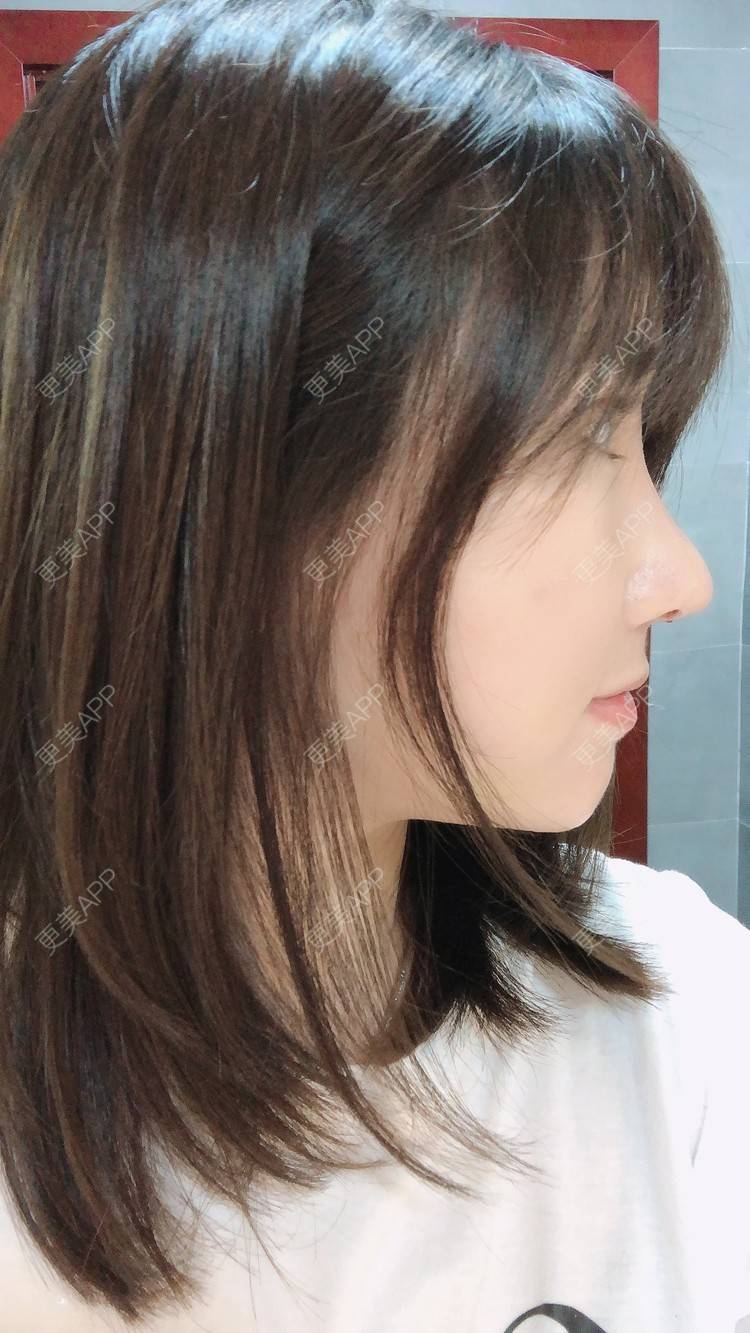更美 - 柏鈤舊懜越的鼻部多项经验 | 鼻部多项 | 膨体隆鼻 | 肋软骨隆鼻 | 重庆 | 鼻形态修复
