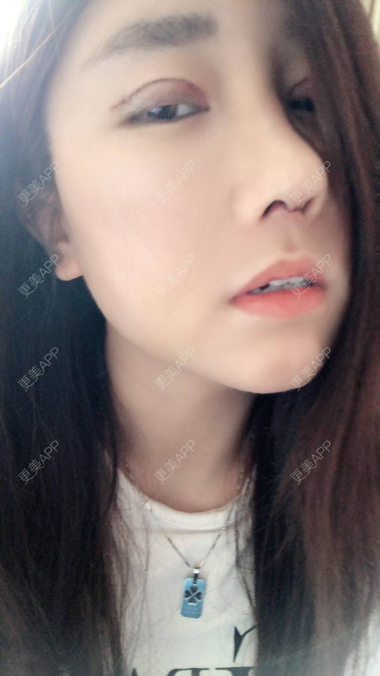 更美 - 柏鈤舊懜越的鼻部多项经验 | 鼻部多项 | 膨体隆鼻 | 肋软骨隆鼻 | 重庆 | 鼻形态修复