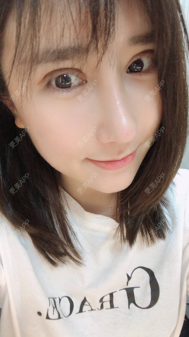 更美 - 柏鈤舊懜越的鼻部多项经验 | 鼻部多项 | 膨体隆鼻 | 肋软骨隆鼻 | 重庆 | 鼻形态修复