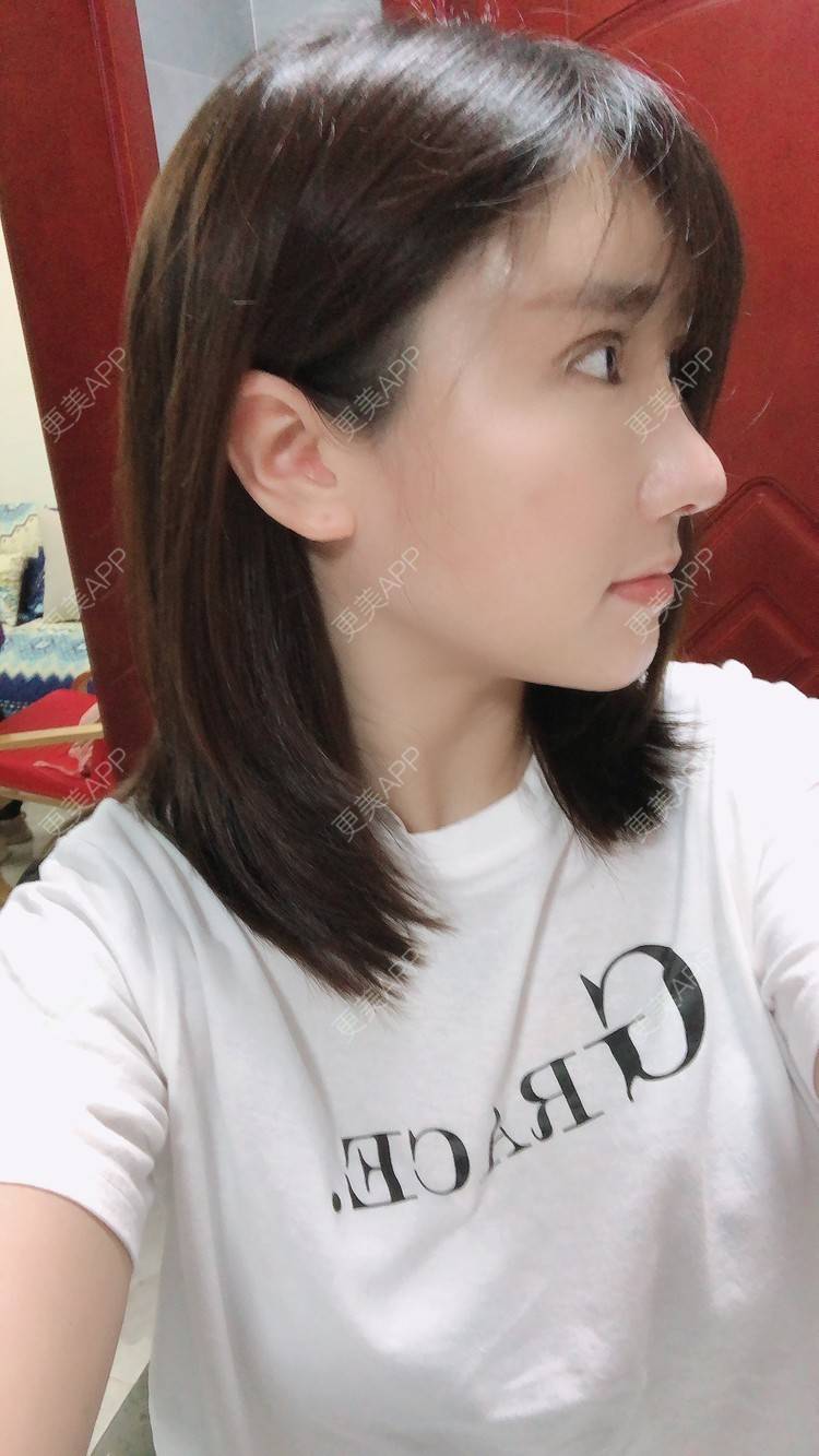 更美 - 柏鈤舊懜越的鼻部多项经验 | 鼻部多项 | 膨体隆鼻 | 肋软骨隆鼻 | 重庆 | 鼻形态修复
