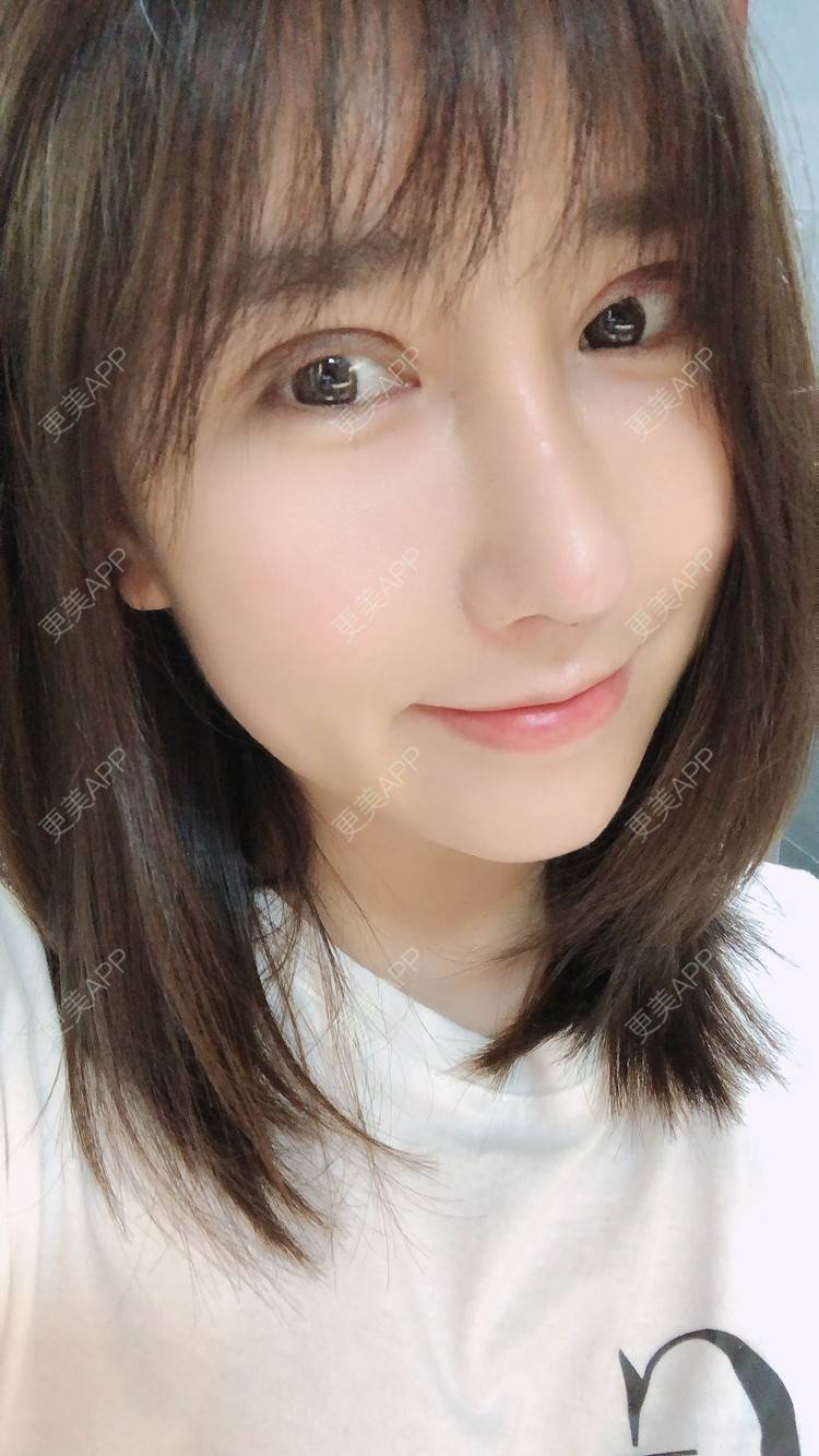 更美 - 柏鈤舊懜越的鼻部多项经验 | 鼻部多项 | 膨体隆鼻 | 肋软骨隆鼻 | 重庆 | 鼻形态修复