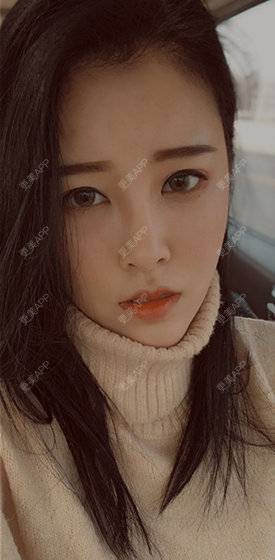 更美 - 更美用户gvlEw1XIyK的红蓝光清痘经验 | 成都 | 视频日记 | 超声提升 | 红蓝光清痘 | 注射美白