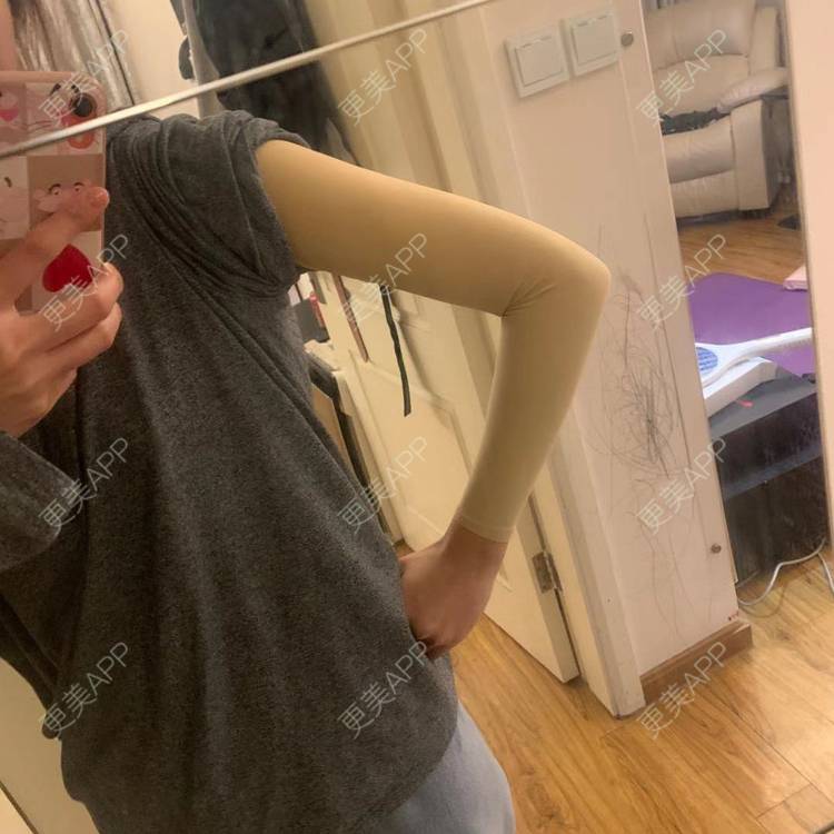 更美用户ljdtdzff3t的手臂吸脂日记