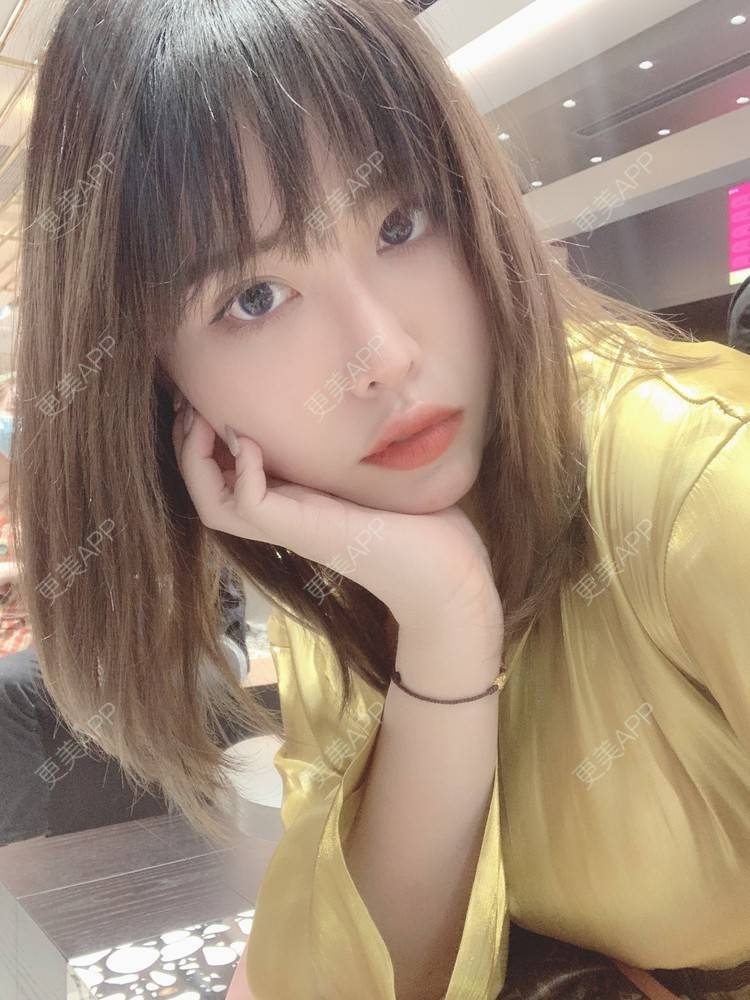 更美 - 未来食神的全切双眼皮经验 | 全切双眼皮 | 开内眼角 | 眼皮下垂矫正 | 重庆 | 双眼皮修复 | 眼部多项 | 开眼角修复