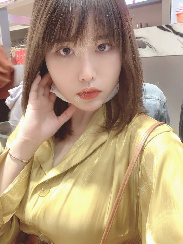 更美 - 未来食神的全切双眼皮经验 | 全切双眼皮 | 开内眼角 | 眼皮下垂矫正 | 重庆 | 双眼皮修复 | 眼部多项 | 开眼角修复