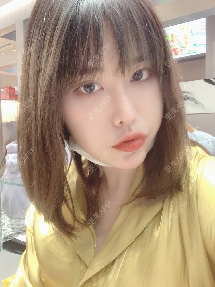 更美 - 未来食神的全切双眼皮经验 | 全切双眼皮 | 开内眼角 | 眼皮下垂矫正 | 重庆 | 双眼皮修复 | 眼部多项 | 开眼角修复