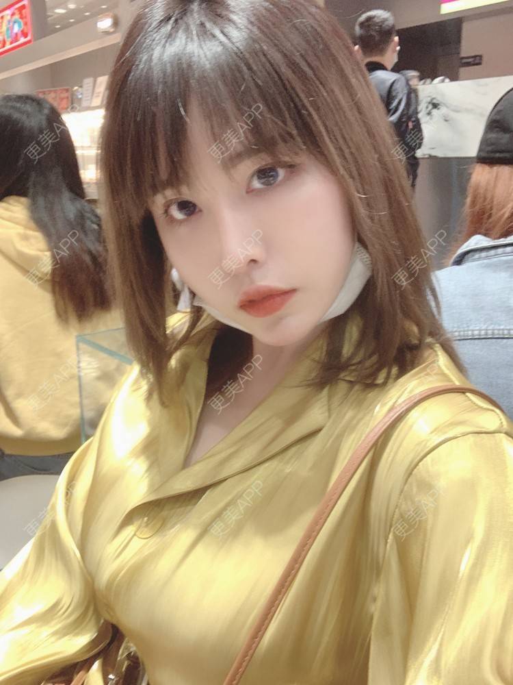 更美 - 未来食神的全切双眼皮经验 | 全切双眼皮 | 开内眼角 | 眼皮下垂矫正 | 重庆 | 双眼皮修复 | 眼部多项 | 开眼角修复