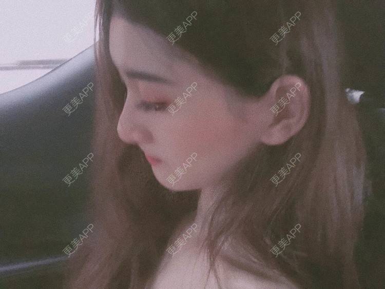 更美 - 最美的期待i的鼻形态修复经验 | 广州 | 鼻形态修复