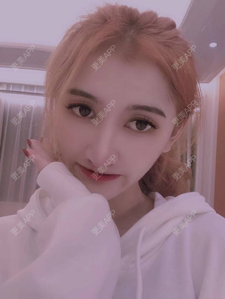 更美 - 最美的期待i的鼻形态修复经验 | 广州 | 鼻形态修复