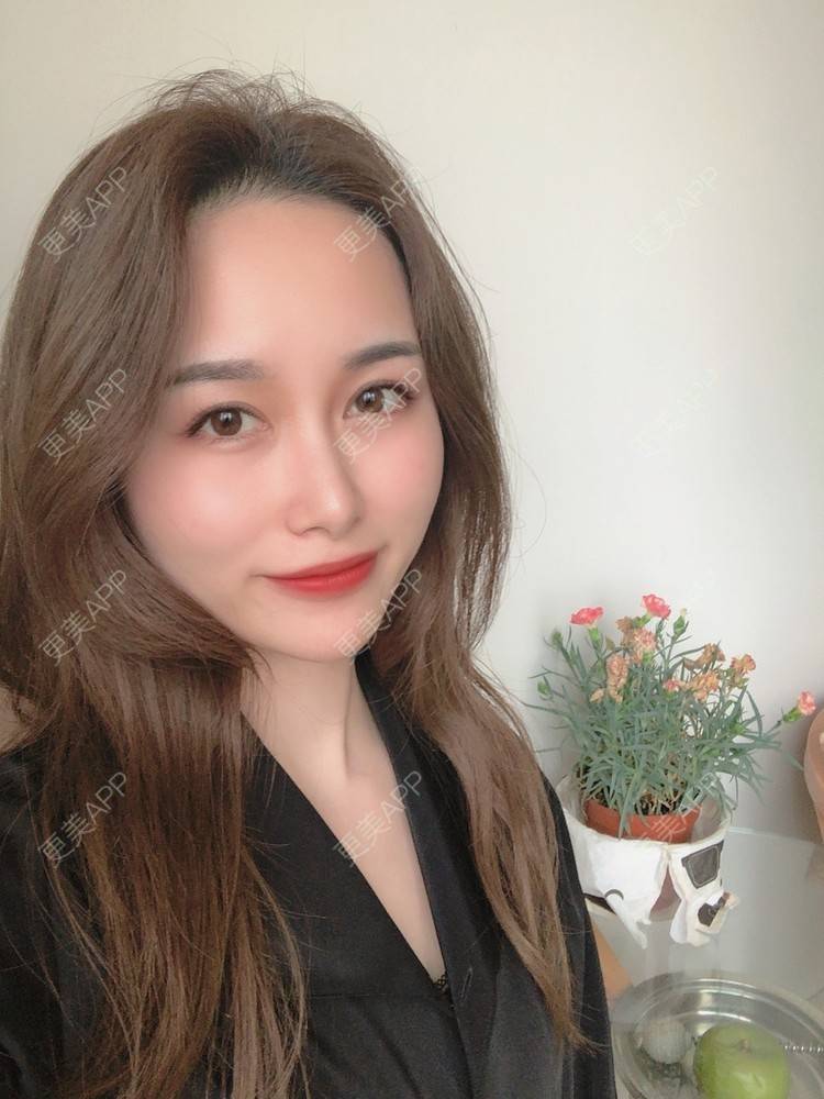 更美 - 甜心泡芙的双眼皮修复经验 | 双眼皮 | 全切双眼皮 | 开内眼角 | 重庆 | 双眼皮修复