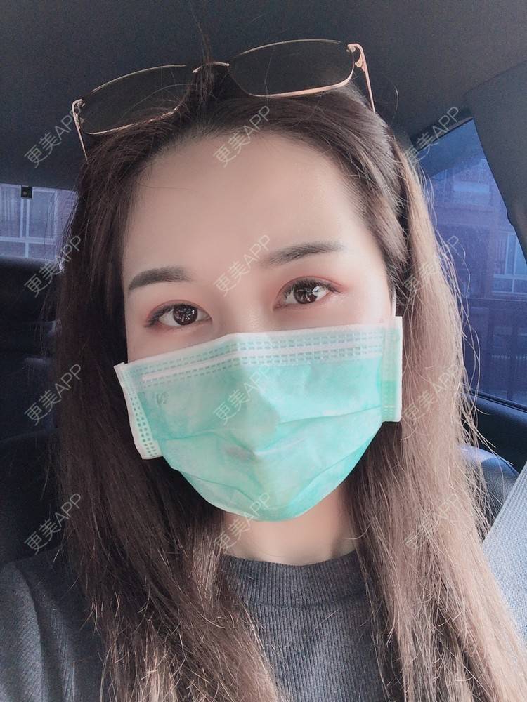 更美 - 甜心泡芙的双眼皮修复经验 | 双眼皮 | 全切双眼皮 | 开内眼角 | 重庆 | 双眼皮修复